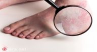 تعرف على الصدفية وأحدث طرق علاجها! تعرف على الصدفية وأحدث طرق علاجها!
