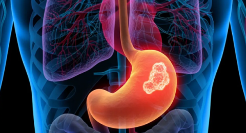 اختراق جديد في علاج سرطان المعدة: الجمع بين العلاج المناعي والكيماوي يقلل من خطر عودة المرض بنسبة 30%