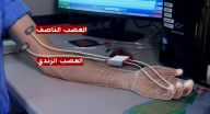 يد صناعية تعيد حاسة اللمس لشخص قطعت يده