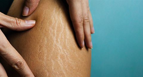 هذه أفضل كريمات علاج السيلوليت وعلامات التمدد