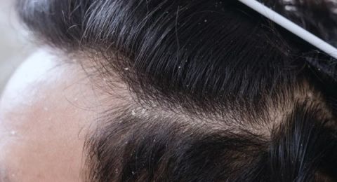 دون علاج.. 3 طرق طبيعية وفعالة للتخلص من قشرة الشعر