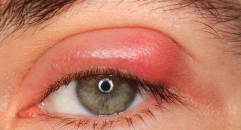 ما هي أعراض التهاب العين؟