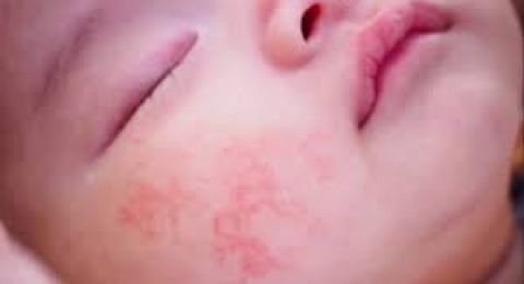 أمل جديد لمنع حساسية الطعام.. آلية وقائية واعدة!