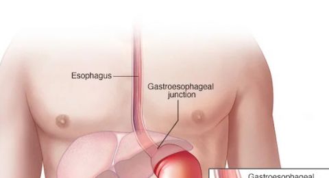 بكتيريا شائعة تهدد ملايين الأشخاص بسرطان المعدة عالميا