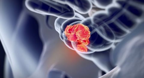 اختبار دم جديد يكشف سرطان القولون بدقة 95% في مراحله المبكرة