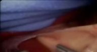 عملية تصغير المعدة عملية تصغير المعدة