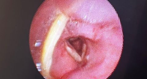 المركز الطبي زيڤ ينقذ حياة سيدة عانت من حالة اختناق حاد وسط مخاوف من مضاعفات خطيرة