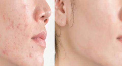 طبيب جلدية يقدم 5 نصائح لتجنب الإصابة بالفطريات في الصيف .. خليها عادة