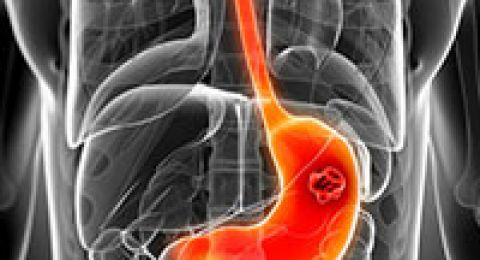 فيروس شائع يتسلل إلى الحمض النووي ويحفز السرطان مباشرة