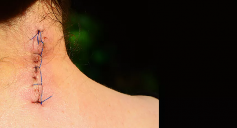 تطوير مادة لاصقة حيوية ذكية قد تحل محل الغرز الجراحية التقليدية