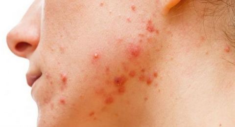 بربع ساعة يوميا.. روتين سريع وفعال لمحاربة حب الشباب