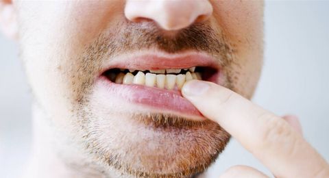 نظام غذائي شهير يقلل التهابات اللثة