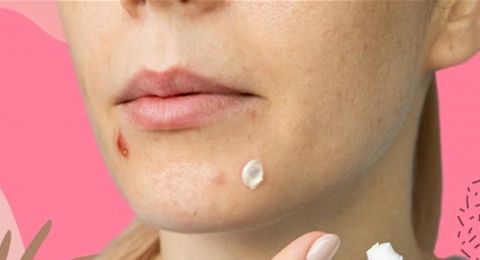 معجون الأسنان والبثور... ماذا يقول خبراء التجميل؟