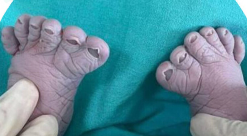 سيدة روسية تثير دهشة الأطباء بعدما أنجبت للمرة الثالثة طفلا بـ12 إصبعا في قدميه Bb0328675