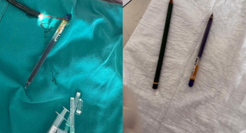 بسبب اضطراب نادر.. استخراج قلمين من معدة شابة تركية!