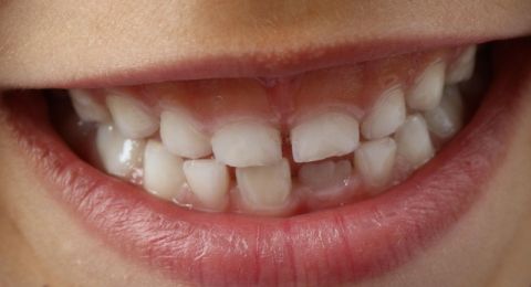 ارتباط وثيق بين صحة اللثة وأمراض القلب!