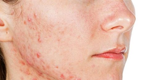 لماذا تظهر حبوب البشرة لدى النساء؟ نصائح طبية لعلاجها بفعالية