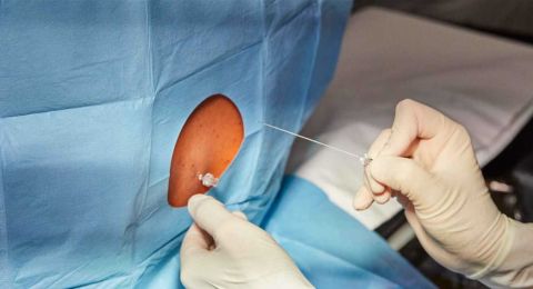 حقنة الظهر قد تنقذ حياة الأمهات.. دراسة تكشف فوائد غير متوقعة