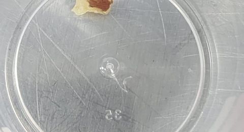 إنقاذ حياة رضيعة اختنقت بقطعة تفاح في مستشفى بني تسيون بحيفا