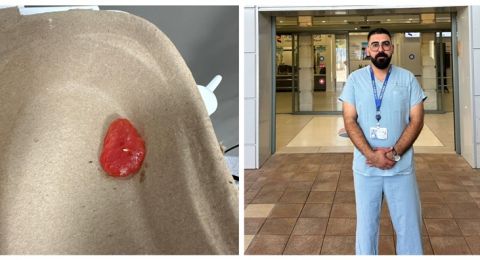 رجل ابتلع قطعة بطيخ كاملة – تدخل سريع ودقيق في المركز الطبي زيف بصَفَد أنقذ حياته