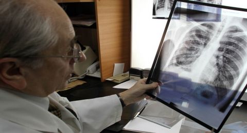 أدوية يمكن أن تنشط السل الكامن