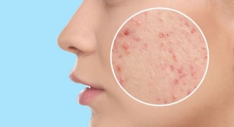 من المراهقة للأربعينات.. 9 أسباب وراء ظهور حب الشباب