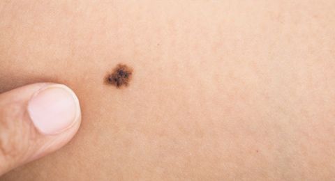 هل إصابة الشامة تؤدي إلى السرطان؟