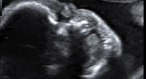 أفغانستان..استخراج جنين من بطن رضيع